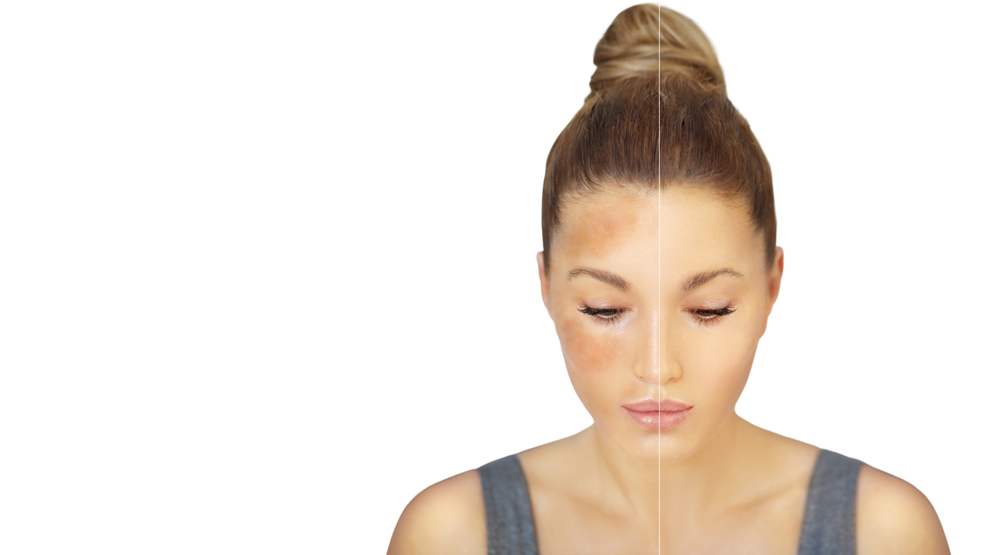 Melasma