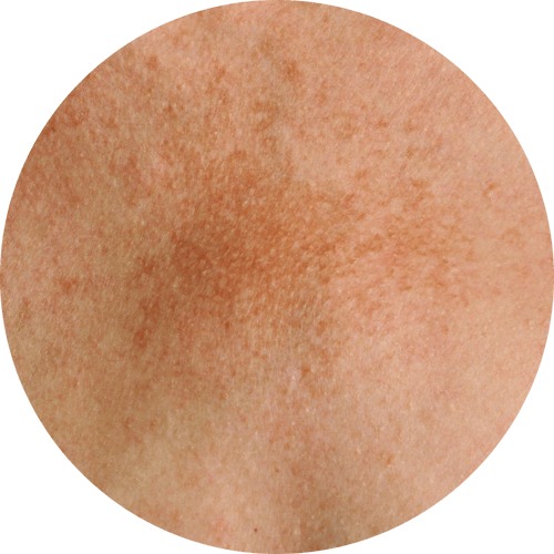 Wie entsteht Melasma
