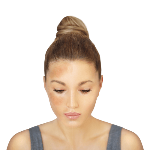 Melasma behandeln