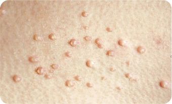 Molluscum contagiosum CryoPen