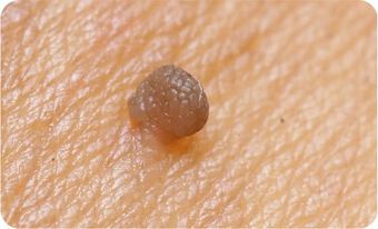 Fibroma molle CryoPen