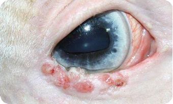 Tumor Augenlid CryoPen