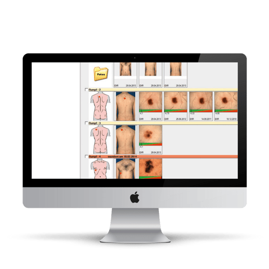 Software Dermatoskopie Befunde