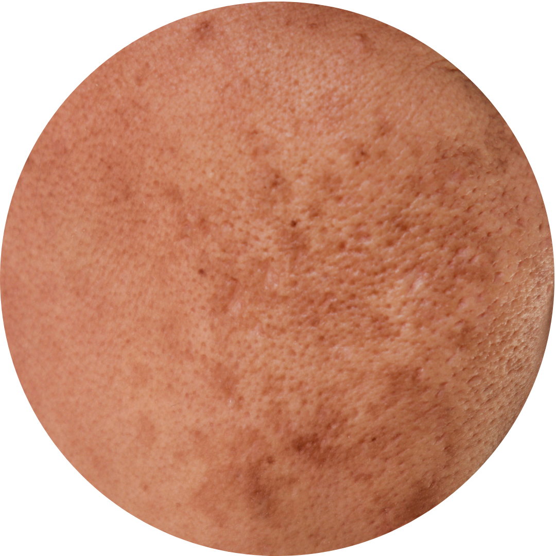 Melasma