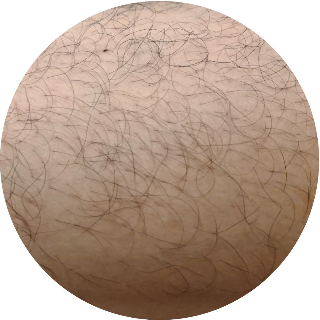 IPL Dauerhafte Haarentfernung