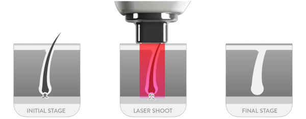 Impulsdauer Diodenlaser