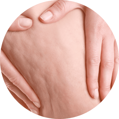 Cellulite Indikation