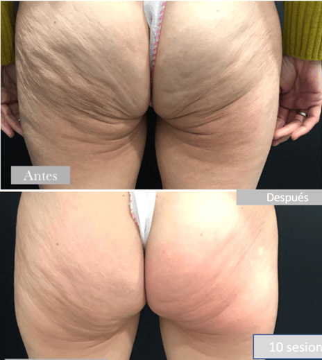 SRF vorher nachher Cellulite