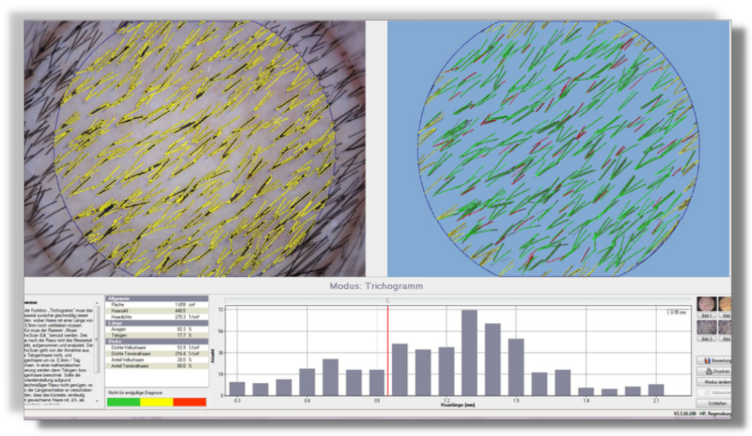 Software zur Haaranalyse bei Haarausfall