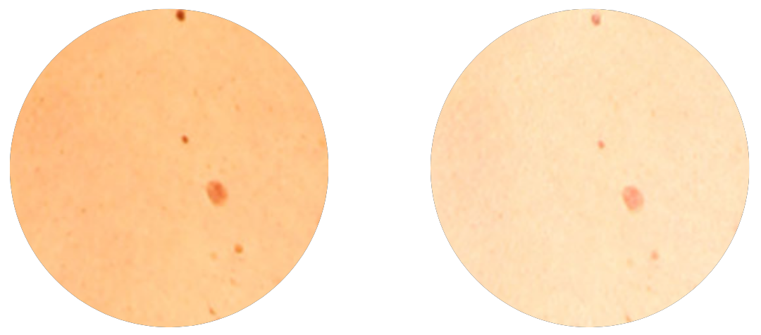 Polarisation Dermatoskop