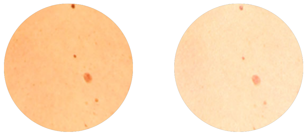 Polarisation Total Body Mapping