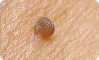 Fibroma Molle