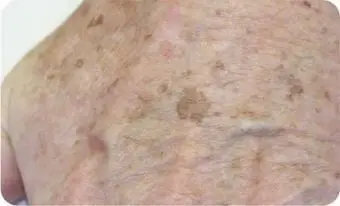 Lentigo Solaris