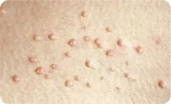 Molluscum Contagiosum