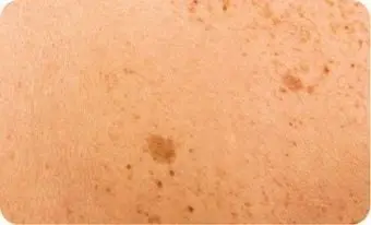 Pigmentfleck