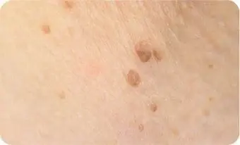 Seborrhoische Keratose