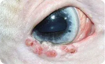 Tumor am Augenlid
